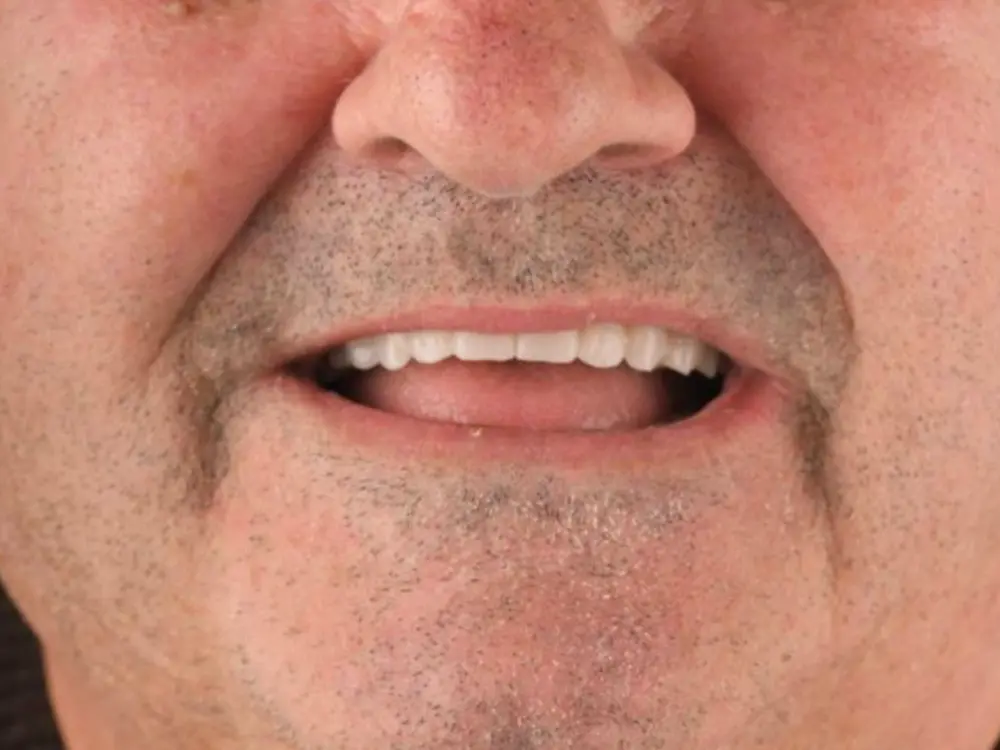 After treatment