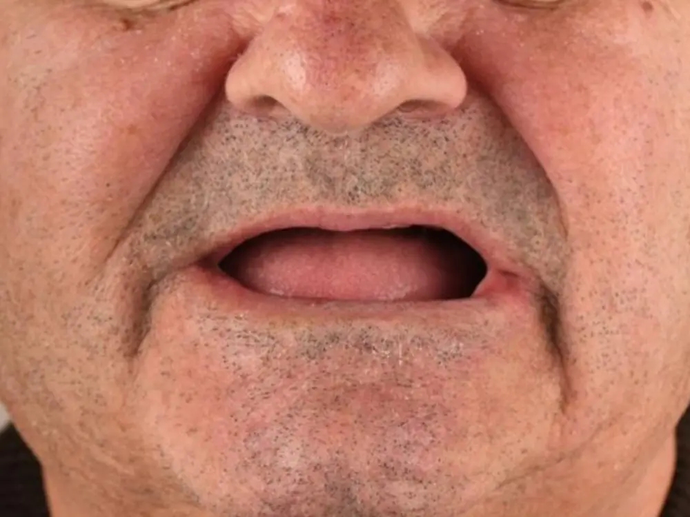 Before treatment