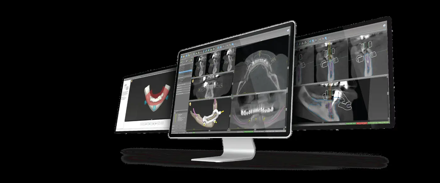 Digital implant planning